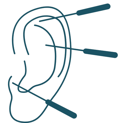 Auriculotherapy is acupuncture on the ear.
