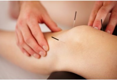 Acupuncture for knee pain.